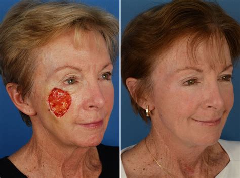 malignant facial melanoma surgery pictures